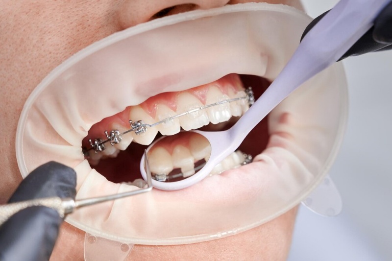 It may hurt, but it’s worth it! Even at an older age, you can still get braces.