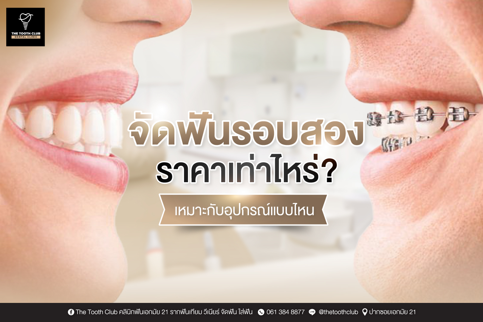จัดฟันรอบสอง ราคาเท่าไหร่ ? เหมาะกับอุปกรณ์แบบไหน