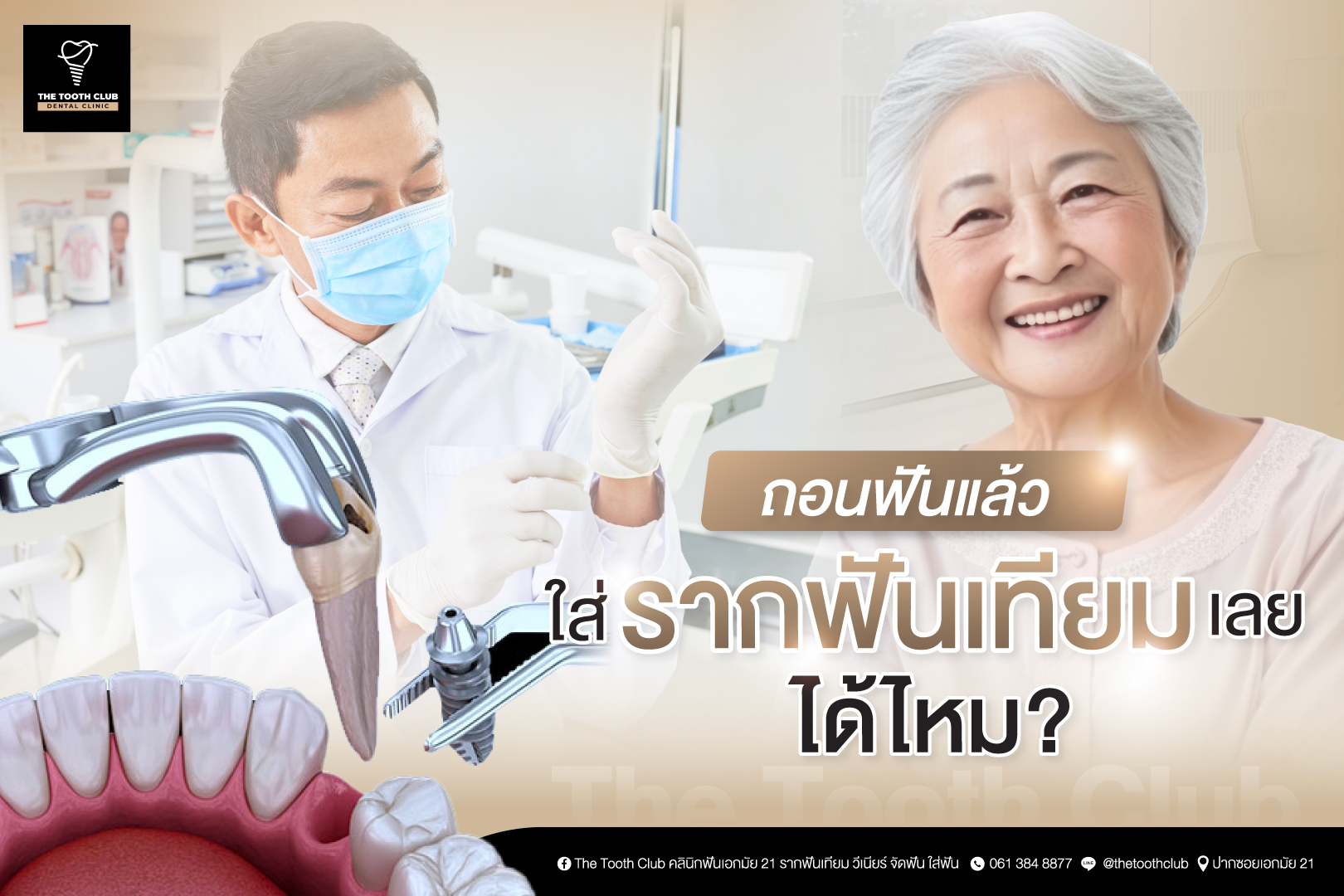 ถอนฟันแล้วใส่รากฟันเทียม เลยได้ไหม?